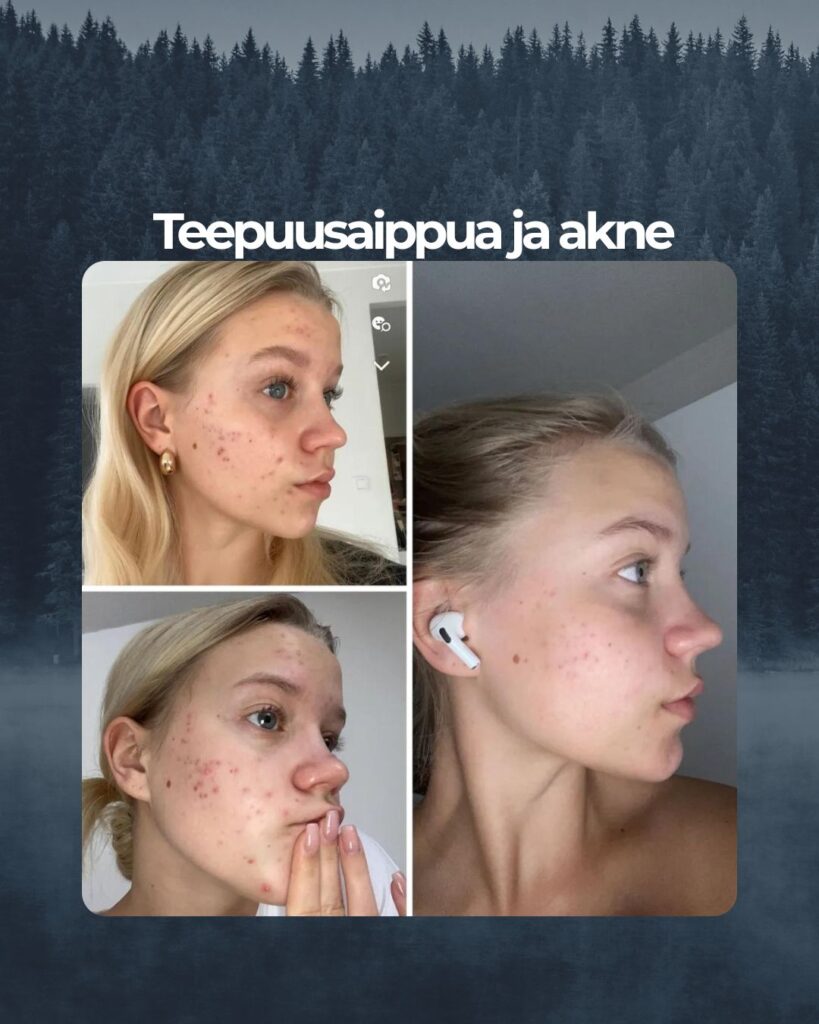 Kuvapalaute: Oon kärsiny aknesta ja aknearvista jo vuosia, oon koittanu kaikkea, maksoin ihonhoidosta parhaimmillaan satoja euroja kuukaudessa, mutta mikään ei toiminut. Sitten tuttava suositteli teidän tuotteita, ja paluuta ei sitten oikeestaan ollutkaan. Mulla on ollut teepuusaippua, ruusu-aloe kasvovesi ja kamomilla sheavoide käytössä nytten 4 kuukautta. Tuotteet toimii kuten luvattu, ne on helppokäyttöisiä ja super riittoisia! Kasvojen iho oli kipeä ja tulehtunut; nytten iho on tasainen, ei kutia ja arvet haalenee päivä päivältä! Iso kiitos teille