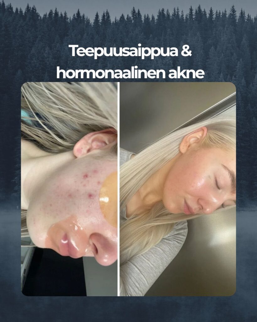 Kuvapalaute: Saaren Taian teepuu palasaippuasta on ollut todella iso apu e-pillerien lopetuksen jälkeiseen hormonaalisen akneen ja epäpuhtauksien kurissa pitämisessä, päädyin tähän tuotteeseen sillä mikään ei enään auttanut edes ammattilaisten tekemät kasvohoidot tai tuotteet vaikka olen itsekkin kosmetologi, suosittelen ehdottomasti kokeilemaan jos muista tuotteista ei ole ollut apua! tämä tuote on jäänyt omaan kylppäriin jäädäkseen, olisimpa löytänyt tämän tuotteen aiemmin, iho paranee päivä päivältä!!😍🫶🏻