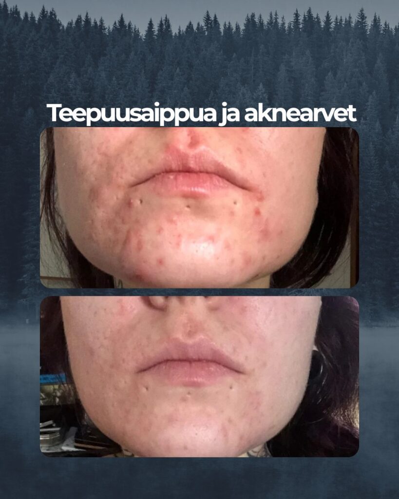 Kuvapalaute:Vuosien taistelun jälkeen tällä ja Saaren Taika teepuusaippualla on lähtenyt sitkeä aikuisiän akne talttumaan. Luulin jo hetken, että pitäisi taas alkaa syömään lääkitystä, mutta näiden kahden tuotteen päivittäisellä käytöllä näppylät pysyvät täysin kurissa ”normiaikana” ja kuukautistenkin aikaan todella huomaamattomina ja harmittomina. Kaikki suuret ja kipeät möhkäleet hävinneet, arvet alkaneet vaalentua ja pitkästä aikaa kehtaa mennä ilman meikkivoidetta. Molemmat tuotteet myös todella riittoisia. Suuri kiitos, näistä en tule luopumaan.