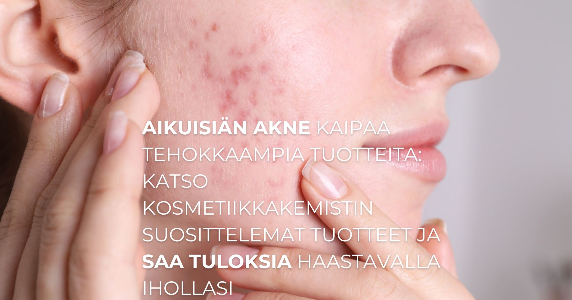 aikuisiän akne kaipaa tehokkaampia tuotteita: katso kosmetiikkakemistin suosittelemat tuotteet ja saa tuloksia haastavalla ihollasi