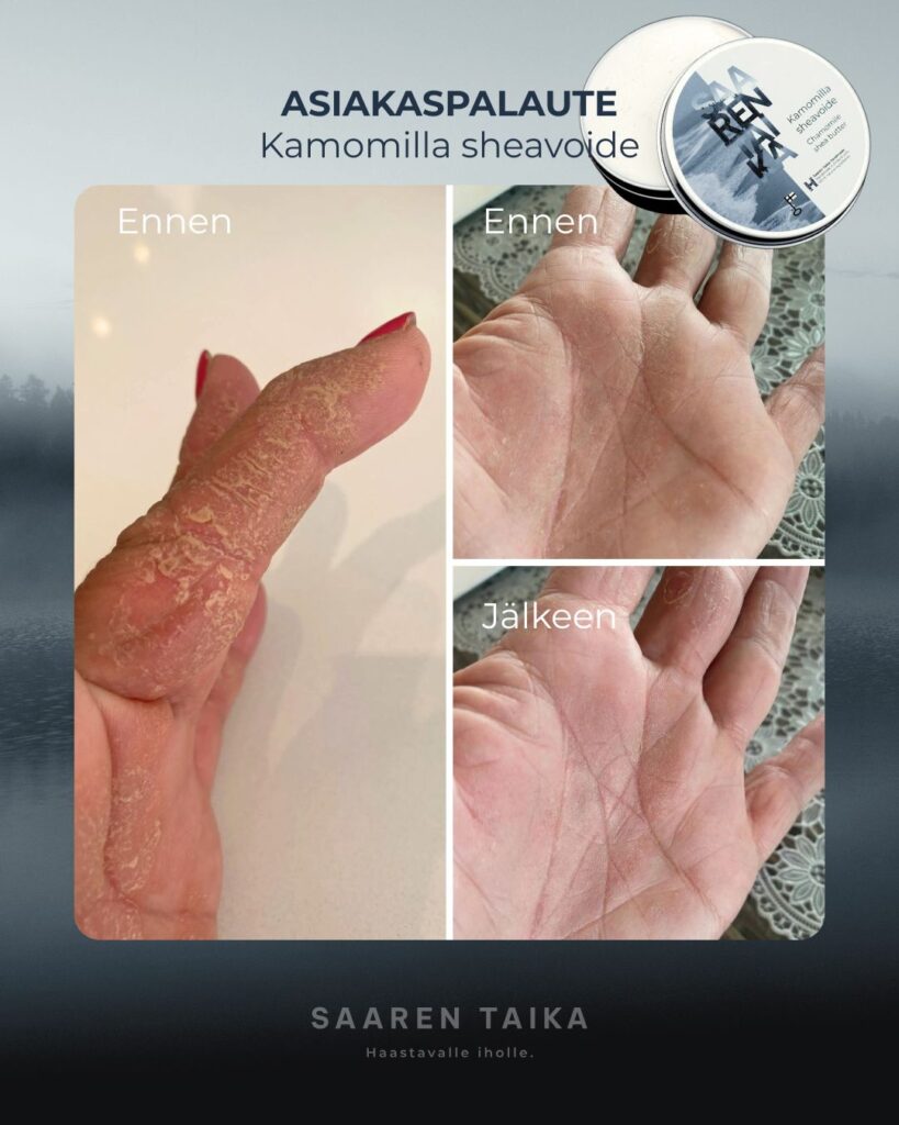 Kamomilla Sheavoide Aivan huippu tuote! Kärsin todella pahasta käsi psoriaksesta jonka hoitamiseen olen käyttänyt monia siis todella monia kortisoni voiteita sekä käynyt ihotautilääkärillä valohoidossa joka myöskään ei auttanut. Näin aikoinaan Saaren Taika mainoksen ja päätin kokeilla koska siitä oli niin mahtavat arvostelut, jotta jospa minäkin saisin siihen apua ja helpotusta. Ja todellakin sain apua! Lisään kuvia jossa näkynee psoriasis pahimmillaan ja kuvia voiteen säännöllisen käytön jälkeen (yöksi laitoin vielä hanskat )