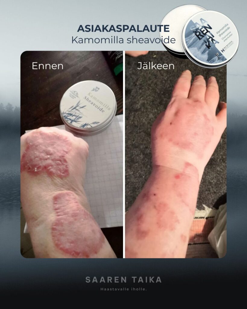 Hei! Aikuisella tyttärelläni on tosi paha Psoriasis. Tilasin hänelle kamomilla Sheavoiteen, jota käyttänyt. Veera Suolasaippua ollut myös käytössä. Ennen käyttöä oleva kuva otettu helmikuussa. Käytön jälkeen kuva nyt maaliskuussa. Läikät ovat vaalentuneet ja mikä parasta iho ei kiristä vaan joustaa ja kutina vähentynyt selkeästi. Tyttäreni sanoi, että tämä voide meni heittämällä jatkoon!