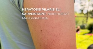 Keratosis pilaris eli sarveistapit: näin hoidat mansikkaihoa