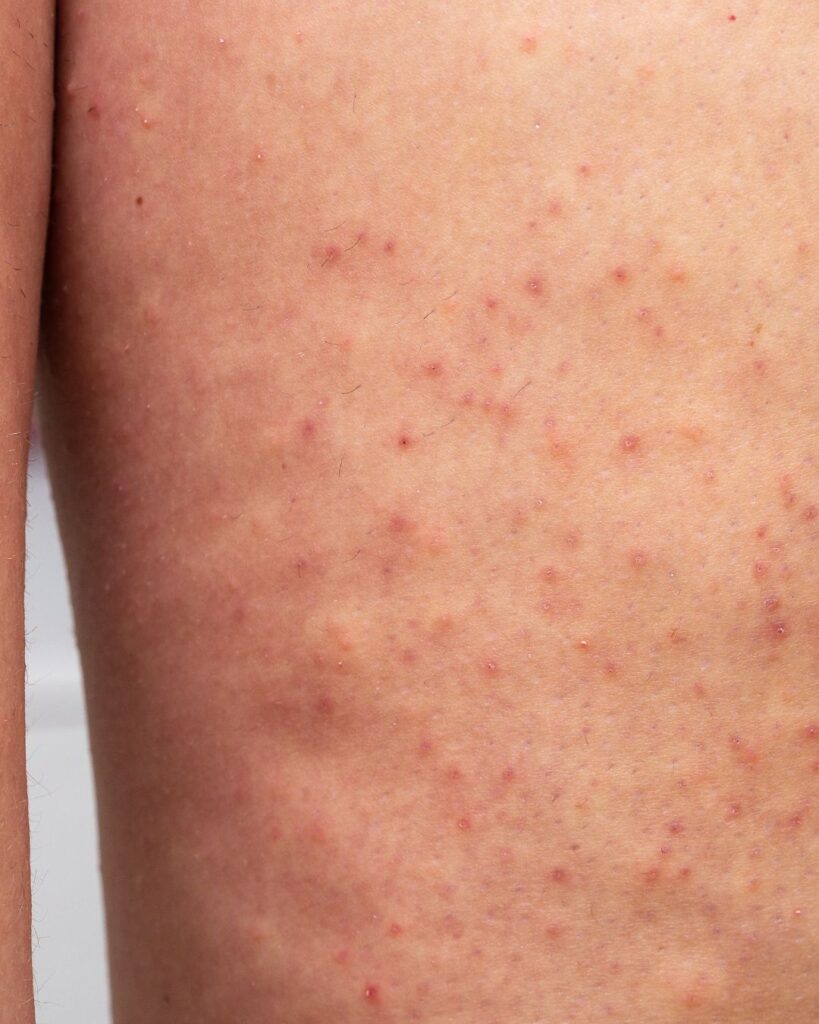 Keratosis pilaris käsivarsissa, reisissä, säärissä