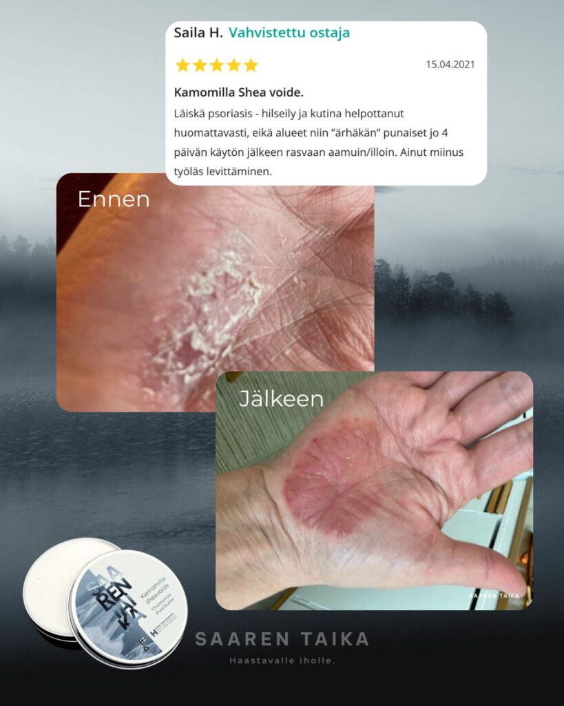"Läiskä psoriasis - hilseily ja kutina helpottanut huomattavasti, eikä alueet niin ”ärhäkän” punaiset jo 4 päivän käytön jälkeen rasvaan aamuin/illoin." -Saila H.