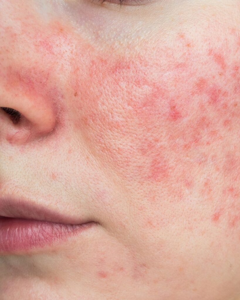 Ruusufinni, eli rosacea, ja siihen usein liittyvä couperosa (näkyvät hiussuonet kasvoissa) eivät ole pelkästään ihon pinnalla tapahtuva ongelma