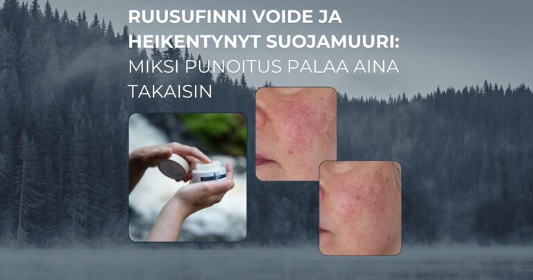 Ruusufinni voide ja heikentynyt suojamuuri miksi punoitus palaa aina takaisin