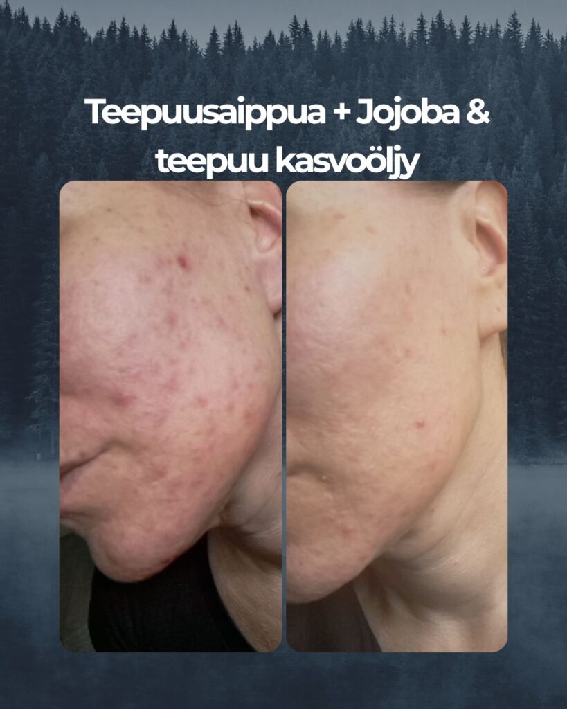40+ akneiho räjähti loppukesästä täysin ja päädyin kokeilemaan tuotteitanne. Ostin ensimmäisenä käyttöön Saaren Taika Teepuusaippuan mutta koska epäilin pelkästään sen tehoa omalle iholleni, tilasin hetken päästä lisäavuksi myös Jojoba & Teepuu kasvoöljyn sekä 24h kosteusvoiteen sekaiholle. Myös Makadamiaöljy sheavoide on ollut satunnaisesti yövoiteena. Epäilin, päädynkö silti jälleen ihotautilääkärille, aiemmin on syöty mm. useita antibioottikuureja, myös isotretinoiini on tullut tutuksi. Iho kuitenkin on nyt n. kuukauden tuotteiden käytön jälkeen rauhoittunut ja osoittanut normalisoitumisen merkkejä. Jatkan taatusti tuotteiden käyttöä, ja vaikka iholla on akne, kaipaa se varsinkin talviaikaan kosteutta. Teidän tuotteilla on varmasti hyvä jatkaa ja katsoa, miten paljon käyttö vielä edistää ihon kuntoa.