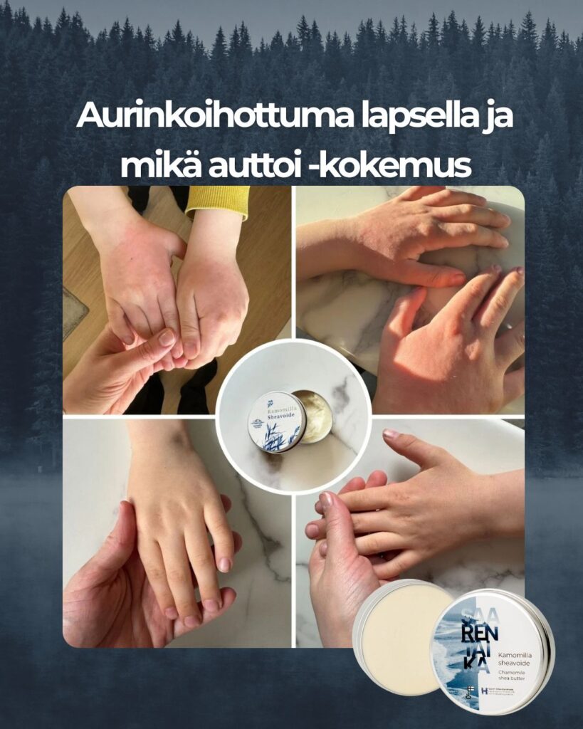 Asiakaspalaute: Kamomilla Sheavoide pelasti meidän 7v pojan pahan aurinkoihottuman käsistä ja niskasta. Kuvien välissä yksi yö heart Laitettiin reilu kerros voidetta ja side voiteen päälle yöksi. Aamulla kädet näytti alemman kuvan mukaiselta.
