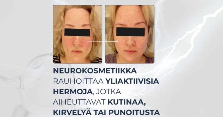 Neurokosmetiikka rauhoittaa yliaktiivisia hermoja, jotka aiheuttavat kutinaa, kirvelyä tai punoitusta