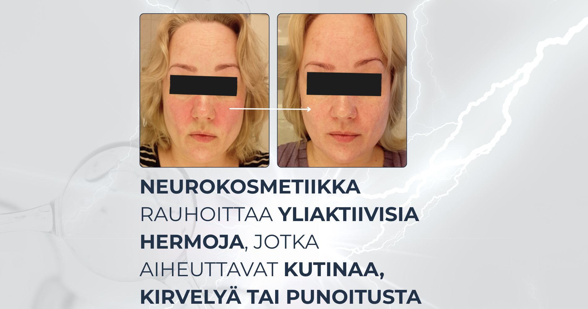 Neurokosmetiikka rauhoittaa yliaktiivisia hermoja, jotka aiheuttavat kutinaa, kirvelyä tai punoitusta