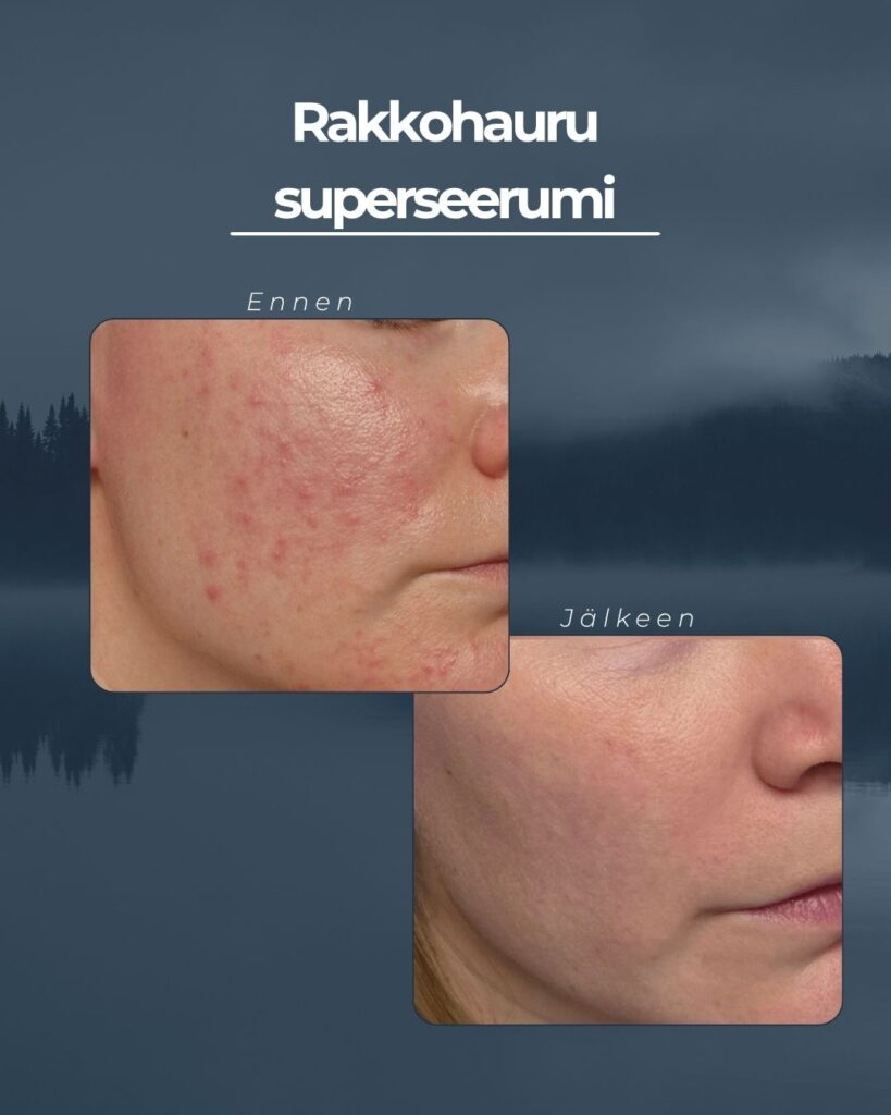 Rakkohauru ihonhoitosarja näkyviä tuloksia superseerumilla