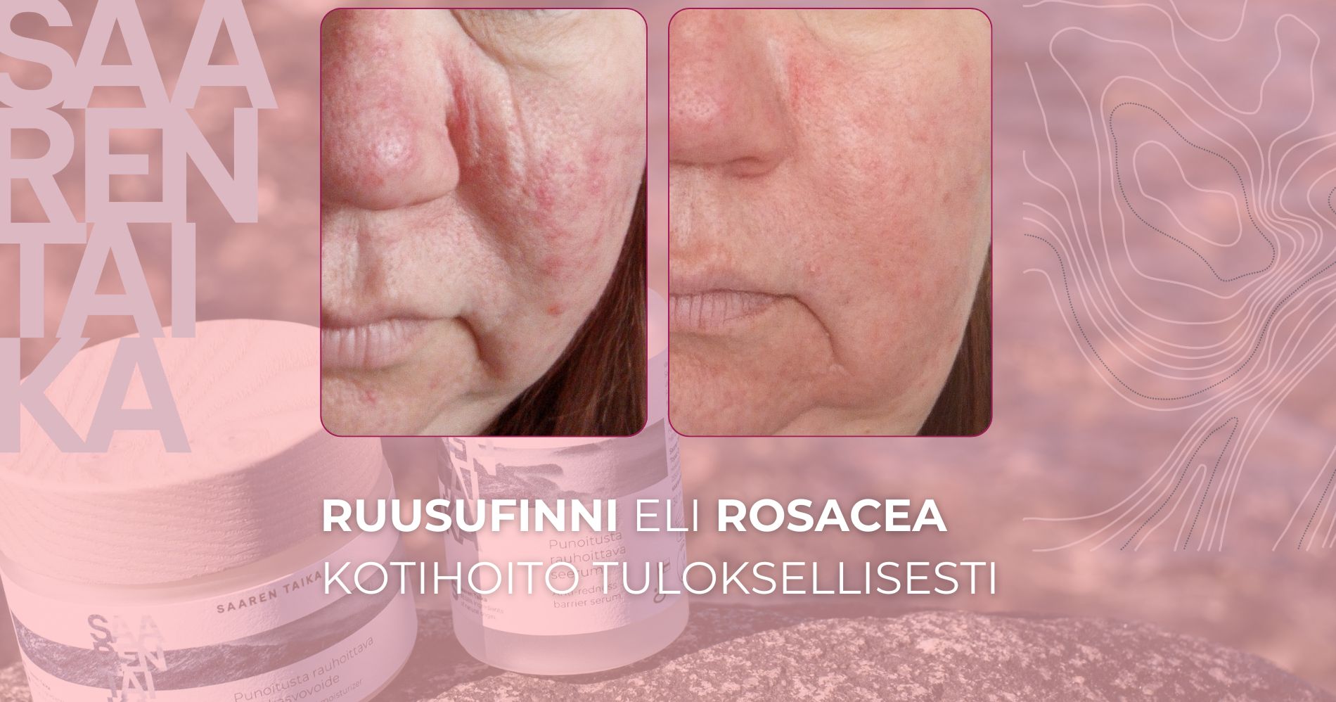 Ruusufinni eli rosacea kotihoito tuloksellisesti