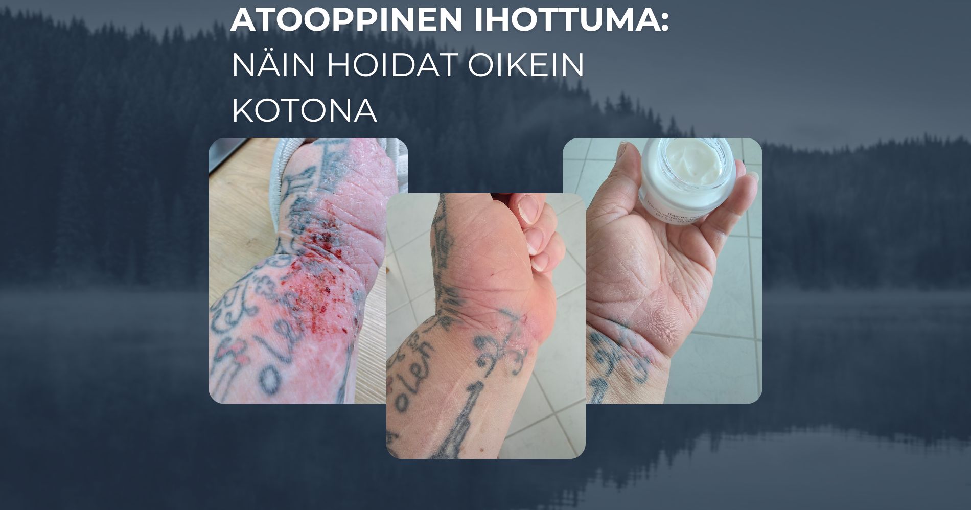 Atooppinen ihottuma ja näin hoidat oikein kotona