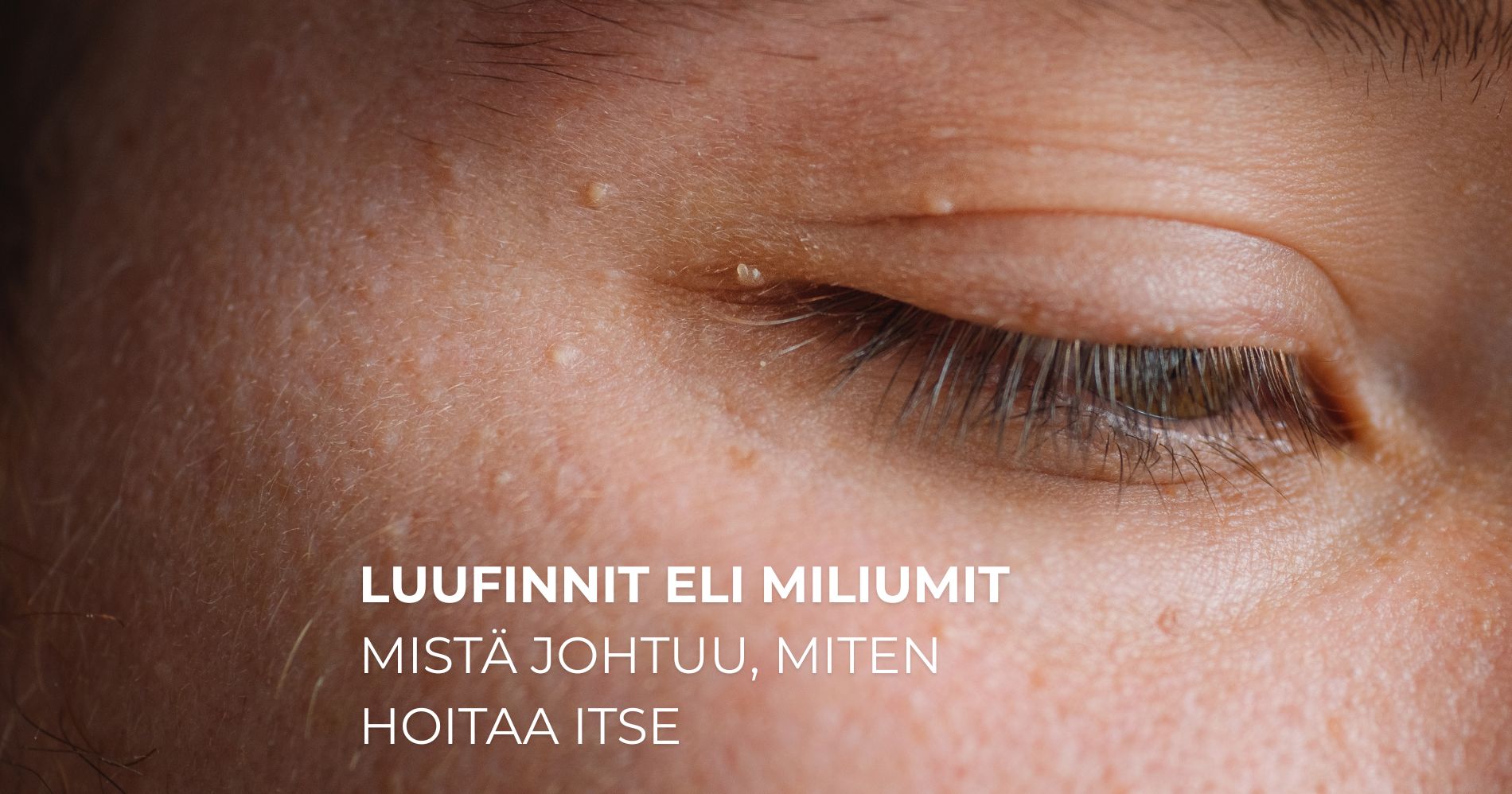 Luufinnit eli miliumit Mistä johtuu, miten hoitaa itse