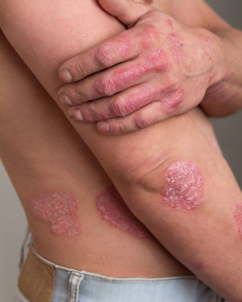 Miehellä näkyy psoriasislaikkuja rystysissä, kyynerpäissä, selässä ja kyljessä.