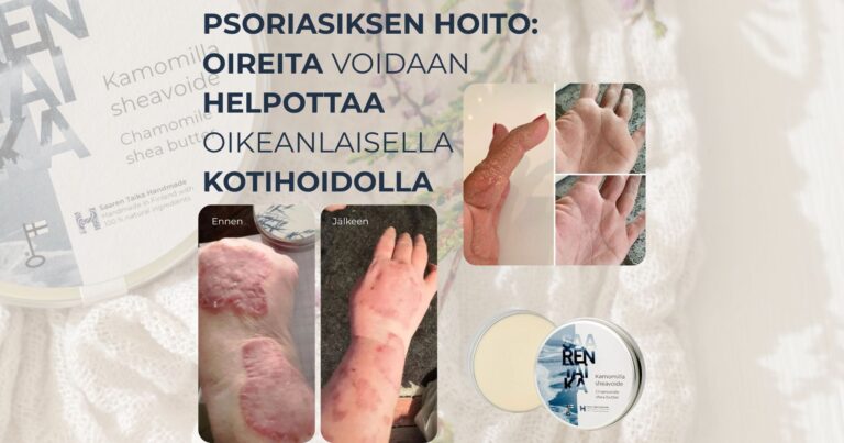 Psoriasiksen hoito perustuu oireiden lievittämiseen ja ihon kunnon ylläpitämiseen, sillä pitkäaikaissairautta ei voi parantaa, mutta oireita voi merkittävästi helpottaa oikeanlaisella kotihoidolla