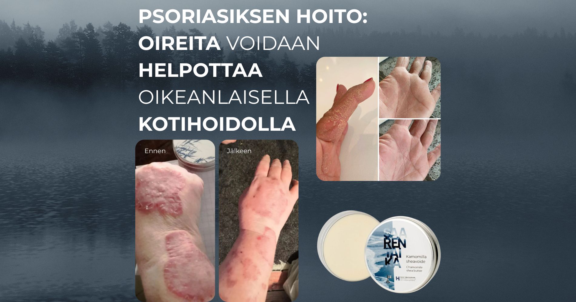 Psoriasiksen hoito perustuu oireiden lievittämiseen ja ihon kunnon ylläpitämiseen, sillä pitkäaikaissairautta ei voi parantaa, mutta oireita voi merkittävästi helpottaa oikeanlaisella kotihoidolla.