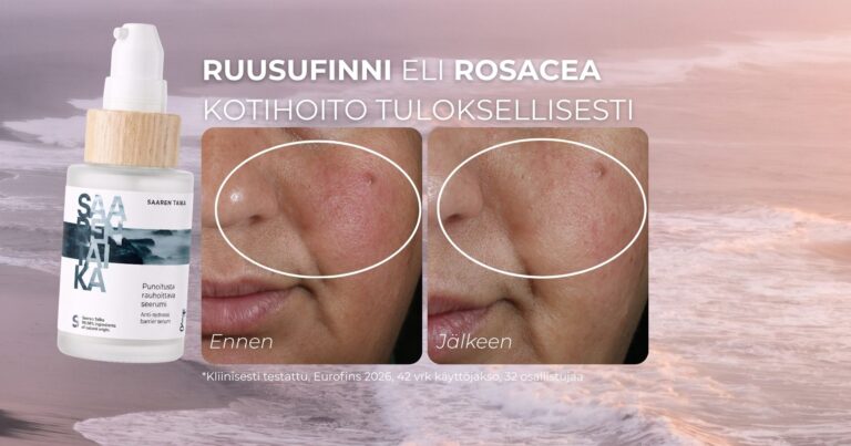 Ruusufinni eli rosacea kotihoito tuloksellisesti