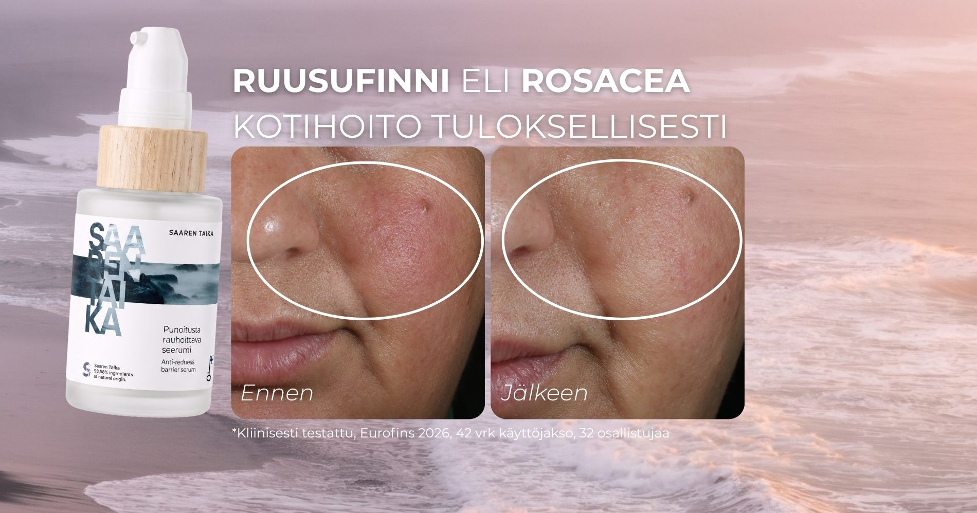 Ruusufinni eli rosacea kotihoito tuloksellisesti