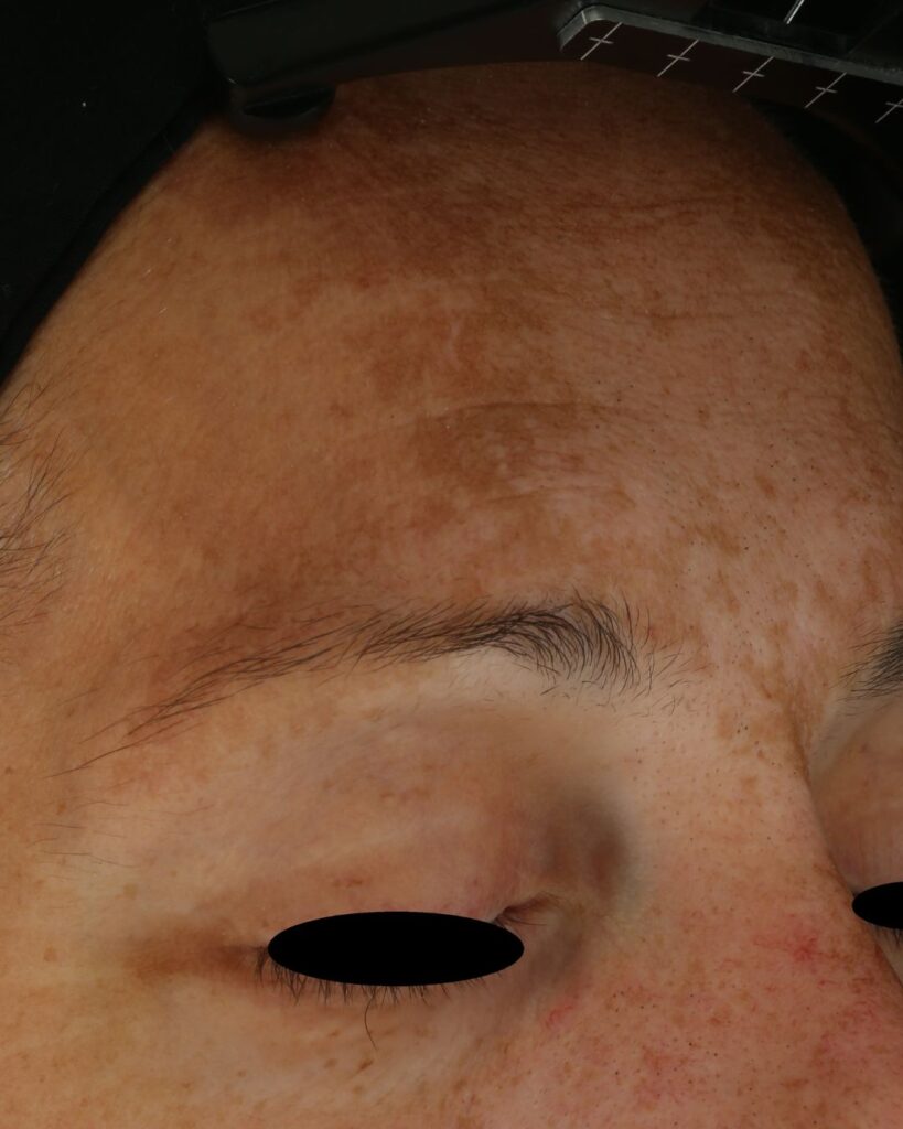 Maksaläiskä eli melasma henkilön otsassa.