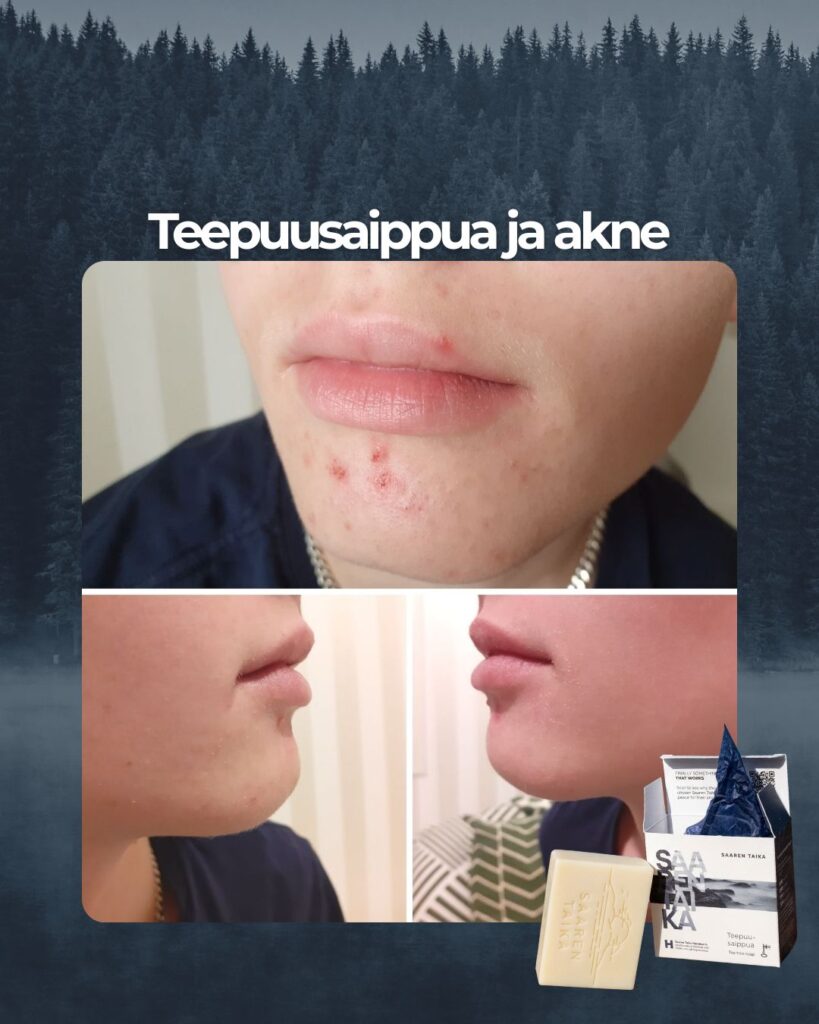 Kuvapalaute: Teini-ikäiset lapseni ovat käyttäneet Teepuusaippuaa nyt puolisen vuotta ja iho on parantunut finneistä ja arvista hyvin. Uusia finnejä tulee vähemmän kuin ennen. Alussa iho puhdistui ja finnit enemmänkin lisääntyivät, mutta jatkoimme käyttöä ja nyt iho on selkeästi kaikilla parempi ja pysynyt kauniimpana. Palasaippua on myös edullinen ja riittoisa: pala riittää kolmella teinillä aamuin illoin käytettynä kuukauden päivät.