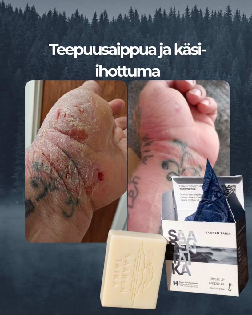 Johanna kehitti Saaren Taika Teepuusaippuan omien kokemustensa pohjalta, sillä jopa pieni määrä sulfaatteja pesuaineessa aiheutti hänelle voimakkaita iho-oireita