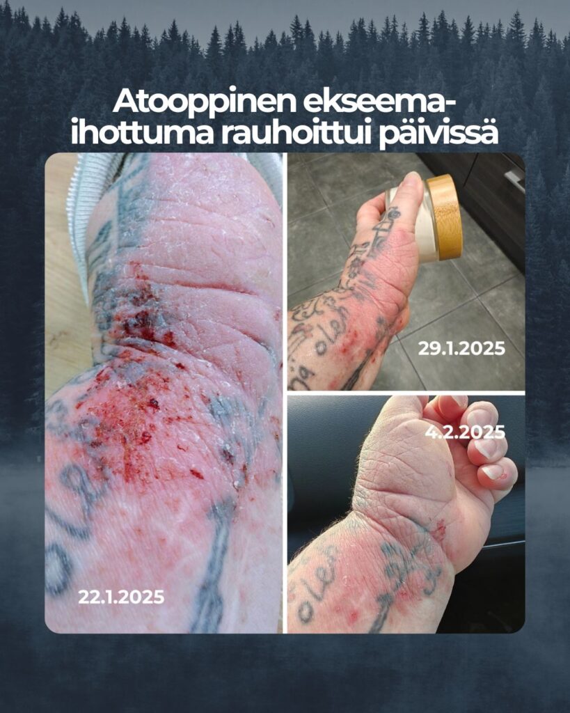 Saaren Taika perustajalla ja tuotekehittäjällä on vuosikymmenten omakohtainen kokemus atooppisen ihottuman kanssa elämisestä.