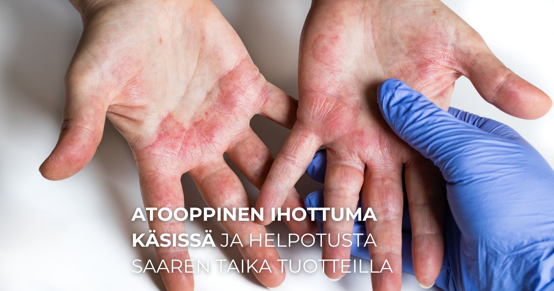 Atooppinen ihottuma käsissä ja nopea apu Saaren Taika tuotteilla