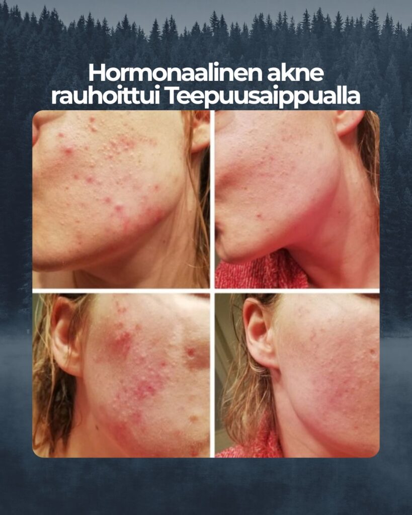Kuvapalaute: Olen pitkään aikonut laittaa palautetta tulemaan teepuusaippuasta, mutta se on vaan aina jäänyt antamatta. Nyt haluaisin kuitenkin kiittää aivan huipputuotteesta, joka auttoi minua selättämään pahan aknen. :) Vuonna 2020 minulle alkoi tulemaan tosi kipeitä ja isoja ihonalaisia näppylöitä poskien alueelle. Samaan aikaan jouduin pitämään töissä maskia koko ajan ja se vain pahensi aknea päivä toisensa jälkeen. Jossain vaiheessa ihon tulehduskierre meni vain pahemmaksi ja jopa nukkuminen alkoi olla inhottavaa kun iho oli niin kipeä. Jopa ihon peseminen sattui paljon. Koetin monenlaista apteekkituotetta ja kävin myös ihotautilääkärillä. En kuitenkaan voinut aloittaa lääkekuuria akneen, joten itsehoito oli ainoa vaihtoehto. Iho tuntui menevän vain pahemmaksi ja mikään ei tuonut helpotusta. Päätin vielä kuitenkin koettaa teepuusaippuaa kun olin kuullut siitä pari hyvää kokemusta tuttavilta. Ensimmäinen kuva on otettu noin viikon käytön jälkeen. Iho oli todella punainen ja täynnä kipeitä näppyjä. Ensimmäisen parin viikon aikana tuntui että ei tästäkään taida olla apua, mutta kun kuukausi oli mennyt olin jo huomannut, ettei uusia näppyjä ole ilmaantunut enää. Olin kuitenkin edelleen hieman skeptinen, koska ajattelin, ettei hormonaaliseen akneen voi saada apua saippualla. Seuraava kuva on otettu n. 4 kk käytön aloittamisesta ja ero on aivan käsittämätön! En osannut kyllä odottaa tuotteen olevan noin tehokas! Tämän jälkeen iho on vain parantunut entisestään ja nykytilanne on todella hyvä (kolmas kuva). Tosi monet ystävät ja sukulaiset ovatkin kyselleet, että miten olen saanutkin ihon niin hyvään kuntoon. Näin hyvässä kunnossa ihoni on tuskin ollut ikinä, koska olen koko ikäni kärsinyt jonkinlaisista iho-ongelmista. Mainostan kyllä kaikille mielelläni ihoni salaisuutta. :D Kiitos vielä tuhannesti upeasta tuotteesta! En enää halua vaihtaa mihinkään muuhun.