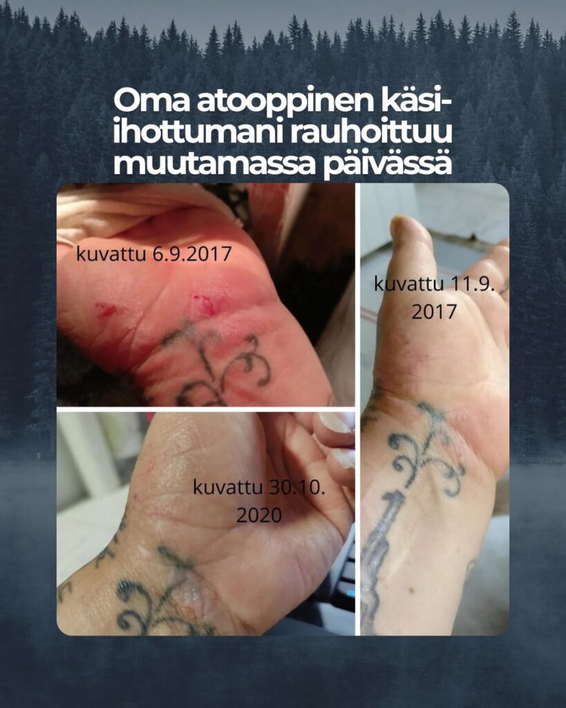 Oma atooppinen käsi-ihottumani ärtyy stressaavina aikoina, mutta Saaren Taika tuotteilla on kutinaa rauhoittava vaikutus, joka auttaa omassa tilanteessani