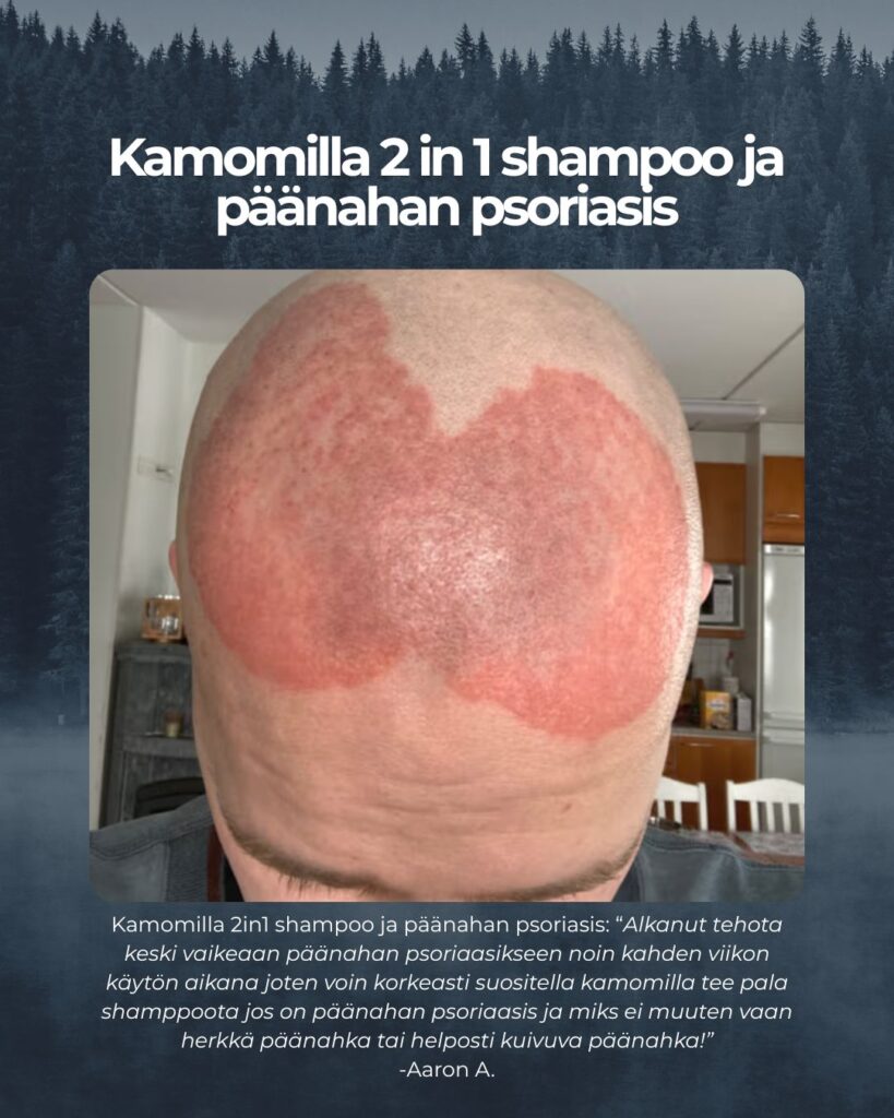 Asiakaspalaute: Kamomilla 2in1 shampoo ja päänahan psoriasis: “Alkanut tehota keski vaikeaan päänahan psoriaasikseen noin kahden viikon käytön aikana joten voin korkeasti suositella kamomilla tee pala shamppoota jos on päänahan psoriaasis ja miks ei muuten vaan herkkä päänahka tai helposti kuivuva päänahka!” -Aaron A.