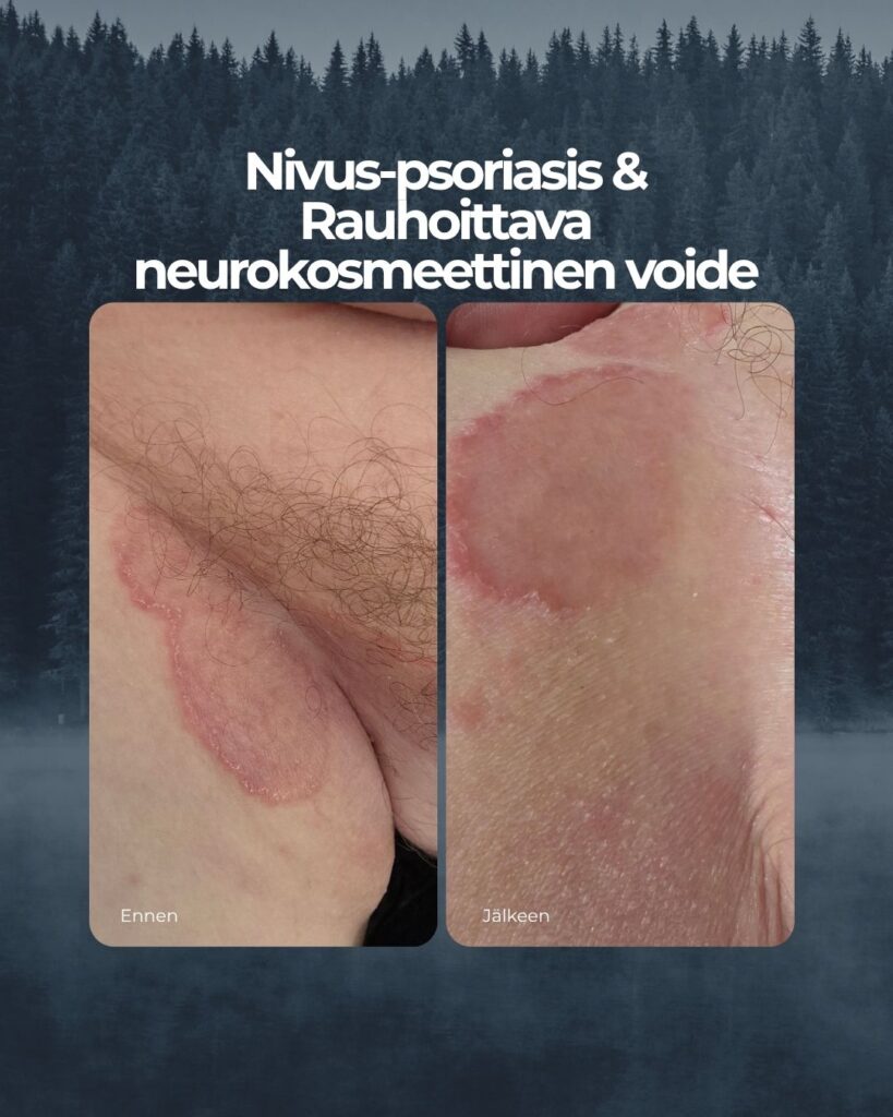 Nivus-psoriasis & Rauhoittava neurokosmeettinen voide ennen-jälkeen kuvat