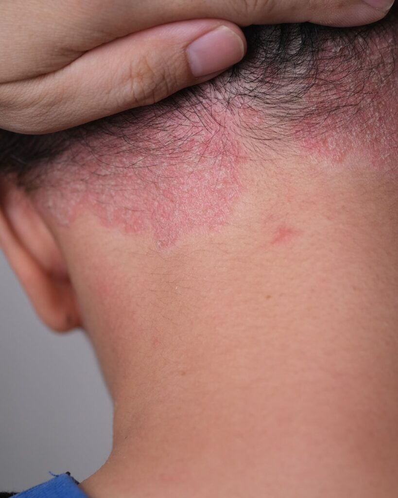 Psoriaattinen päänahka jossa niskassa näkyy psoriasis laikkuja