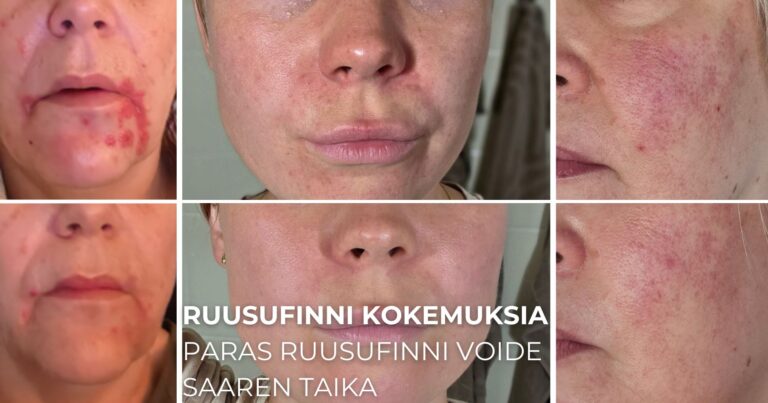Ruusufinni kokemuksia paras ruusufinni voide Saaren Taika