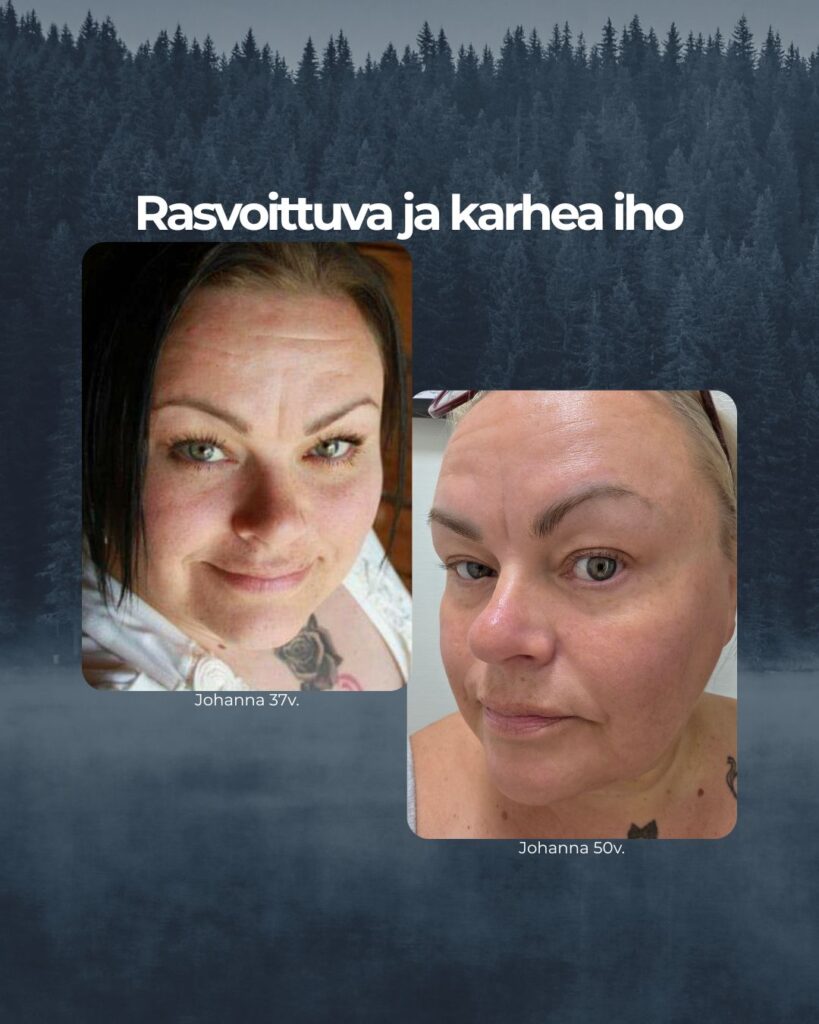 Saaren Taian perustajalla ja tuotekehittäjällä on itsellään pintakuiva, mutta nopeasti rasvoittuva ja karhean tuntuinen iho.