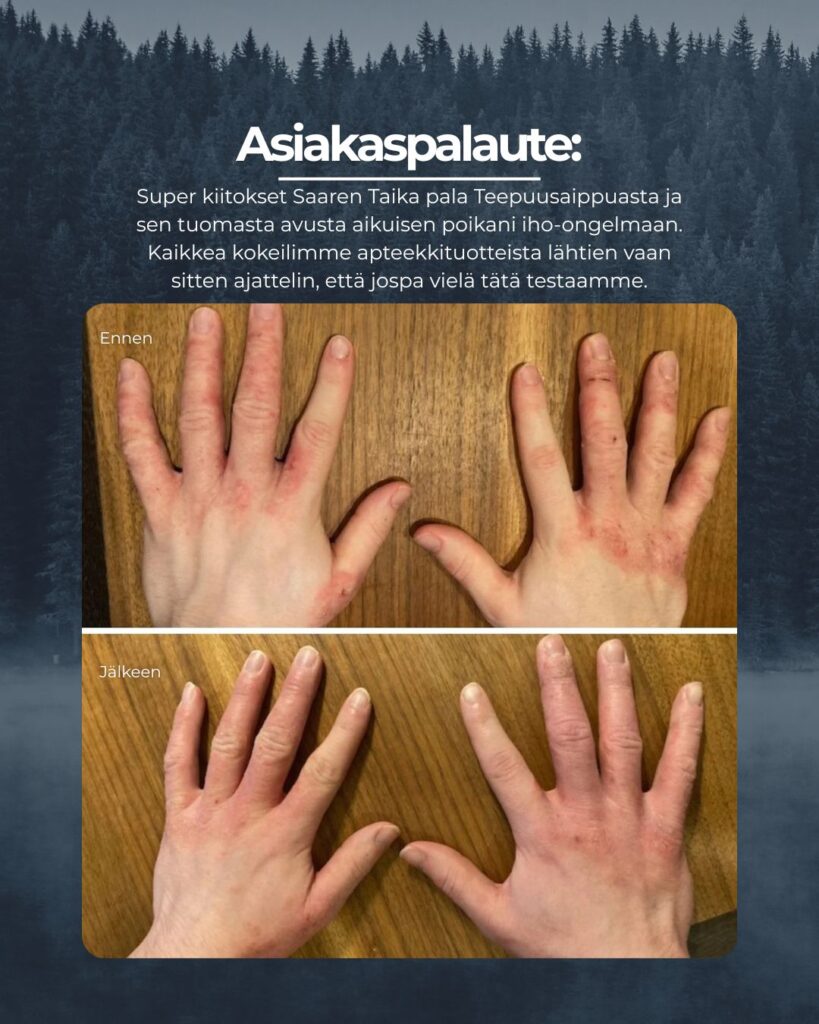 Asiakaspalaute: Hei! Super kiitokset Saaren Taika pala Teepuusaippuasta ja sen tuomasta avusta aikuisen poikani iho-ongelmaan. Kaikkea kokeilimme apteekkituotteista lähtien vaan sitten ajattelin, että jospa vielä tätä testaamme. Ja kyllä kannatti: eka kuvassa on lähtötilanne ja sitten kuva käsistä vajaan kahden viikon käytön jälkeen. Käsissä oli atooppista ihottumaa ja iho kutisee, hilseilee ja on haavoilla. Onhan sitä vielä hieman edelleenkin mutta tilanne on huomattavasti parempi ja mieli sen myötä helpottunut. Ja on hyvä jatkaa!!!
