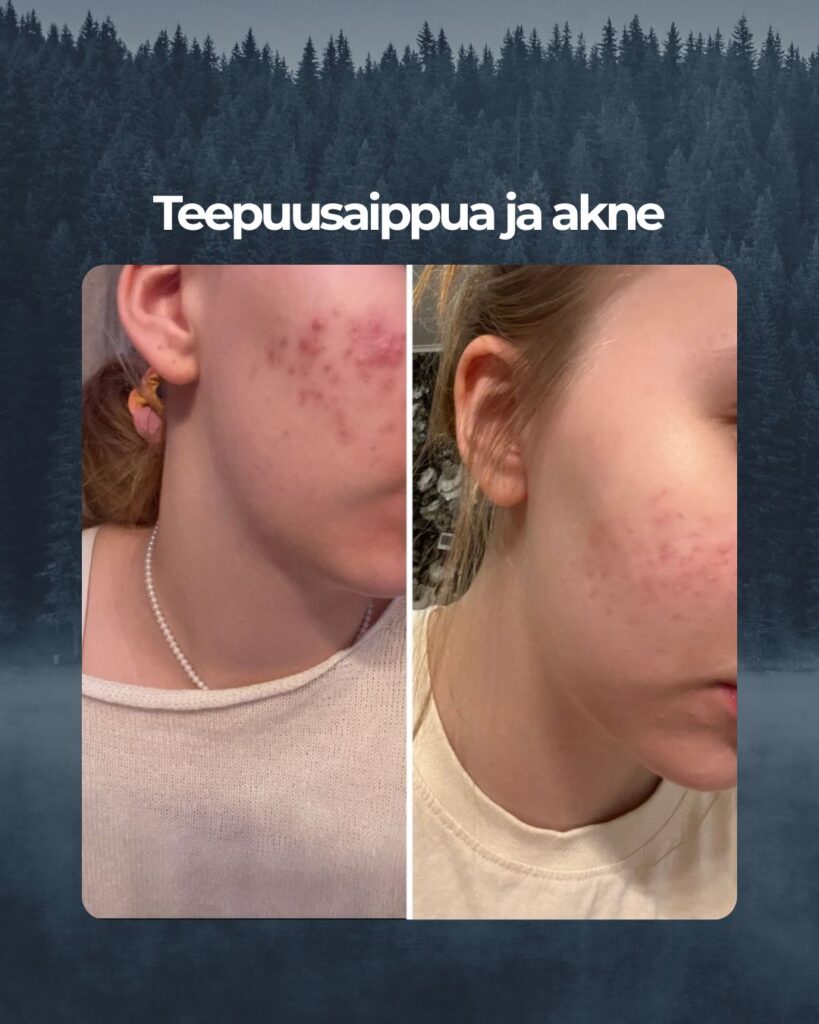 Hei! Tästä saippuasta on ollut tosi paljon apua. Olen käyttänyt teepuusaippuaa nyt 4 kuukautta ja huomaan suuren eron ihossani! Finnit joita minulla ennen oli on kadonnut melkein kokonaan ja jäljellä on enää vain arpia!