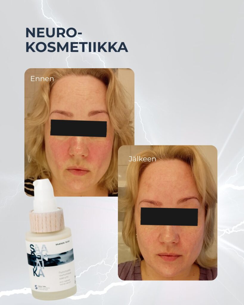 Neurokosmetiikkaa herkälle ja punoittavalle iholle. Kuvassa tuotetestaajan ennen ja jälkeen kuvat, käytössä Punoitusta rauhoittava seerumi