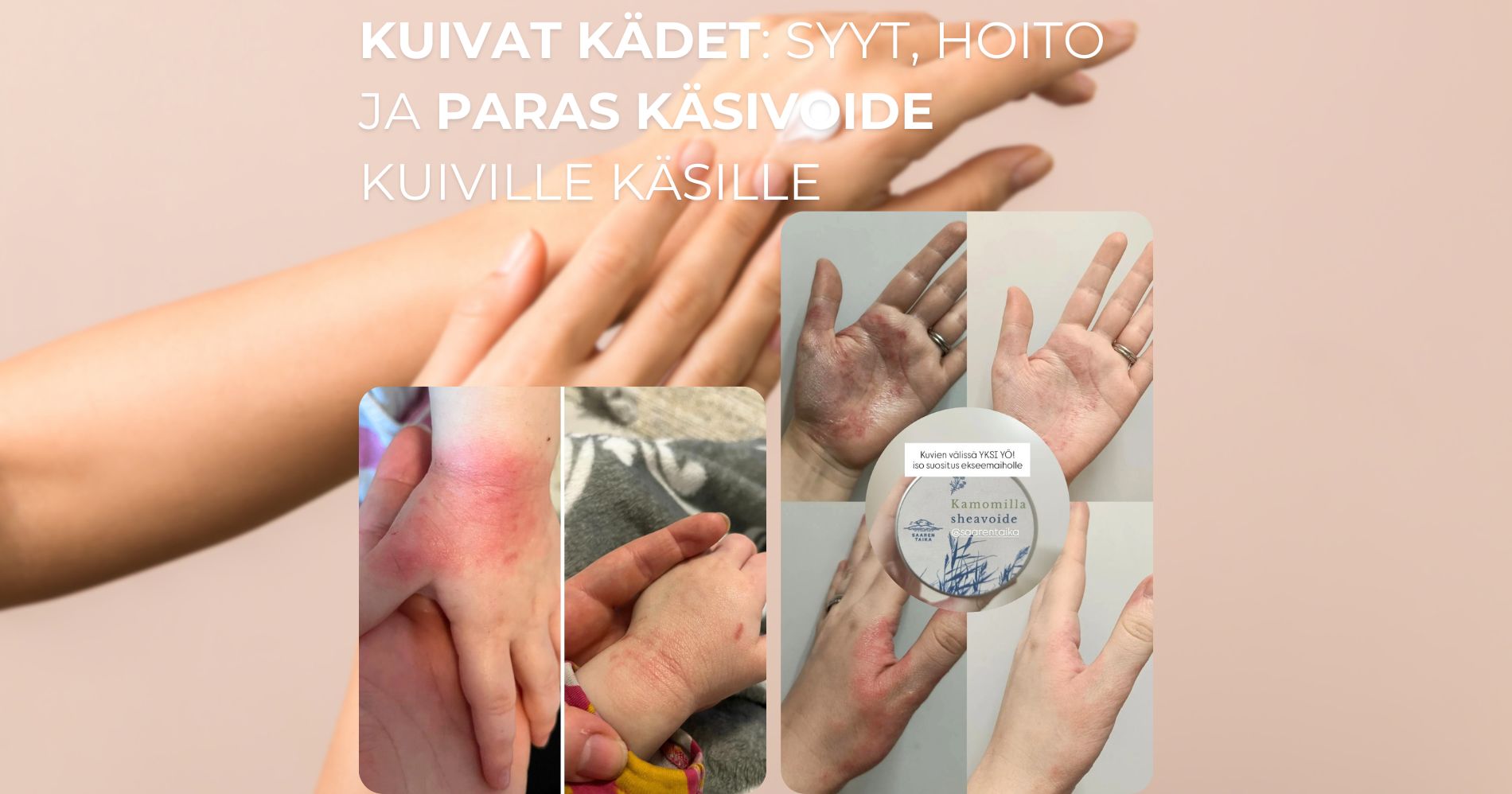 Kuivat kädet syyt, hoito ja paras käsivoide kuiville käsille