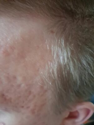 Viimeisen parin vuoden aikana ihoni on alkanut muuttumaan. Hormoni finnejä ja punaisuutta, kummatkin asioita joista en ole aiemmin kärsinyt. Viime viikkoina tilanne vain paheni ja otsakin (jonka iho aiemmin oli ollut finnitön) alkoi kukkimaan. Tilasin aiemmin ostamani Teepuusaippuan kaveriksi Spot Control tehovoiteen ja Appelsiini-Kamomilla-Aloe Kasvoveden. Iho on jo viikossa rauhoittunut huomattavasti. Edelleen näppyjä tahtoo puskea pintaan, mutta yön aikana Spot Control rauhoittaa tilanteen ja aamulla iho näyttää aina paremmalta. Olen erittäin toiveikas tämän tuotteen suhteen!